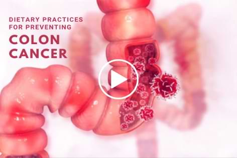 LMU - 03 Reducing Colorectal Cancer Risk: Embracing a Wellness Lifestyle